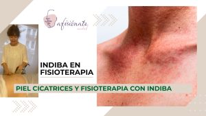 INDIBA PIEL FISIOTERAPIA
