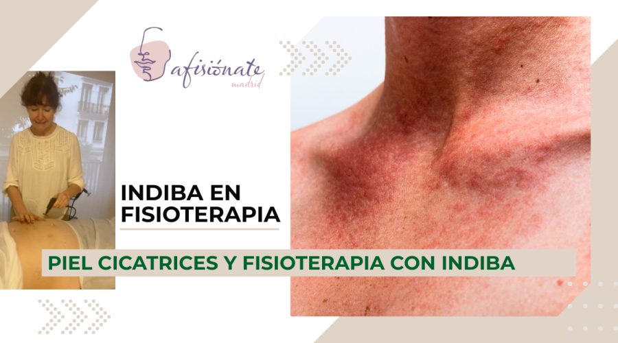 INDIBA PIEL FISIOTERAPIA